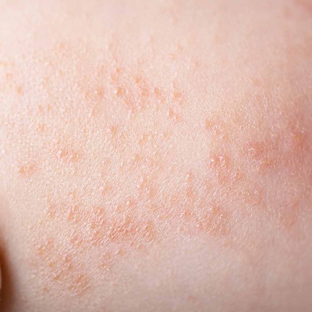 Skincare e Dermatite Seborroica: Una Guida Completa Basata sull'Evidenza